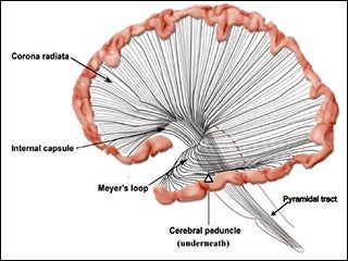 Drawing of the left hemisphere of the brain, including the outermost edge of the brain  connected by radiations of axons to the brainstem and spinal cord.