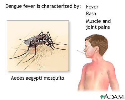 Dengue fever