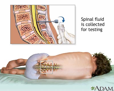 Lumbar puncture (spinal tap)