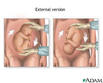 Correcting breech