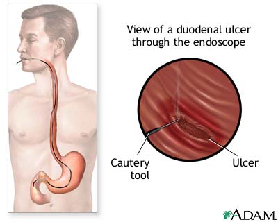 Gastroscopy procedure