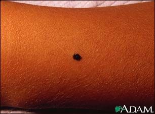 Benign juvenile melanoma