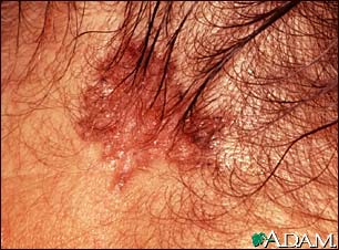 Skin cancer, basal cell carcinoma - pigmented