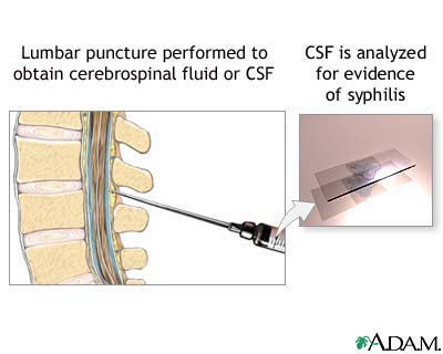 CSF test for syphilis