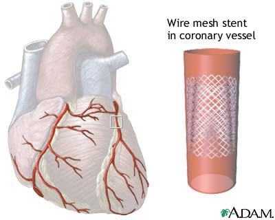 Coronary artery stent