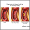 Progressive build-up of plaque in coronary artery