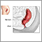 Rectal prolapse repair  - series