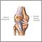 Patellar dislocation